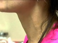 Woman S Abnormal Neck Pulses Caused By Heart Condition Video
