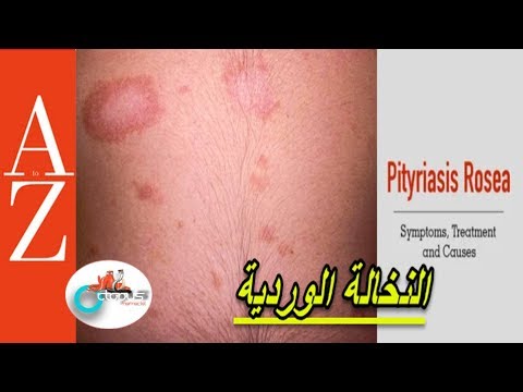       النخالة الوردية اعراضها واسبابها تطور المرض كل اربعاء