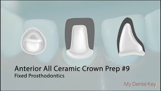 PASS THE CDCA  All Ceramic Anterior Crown Preparation | My Dental Key