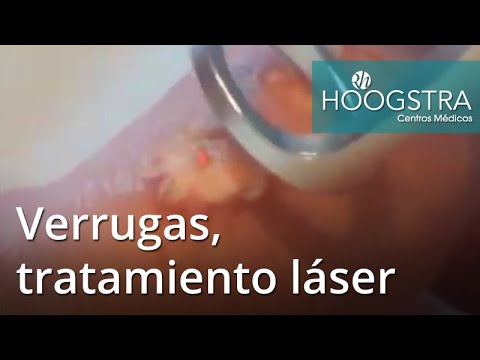 ultrasonido portatil Verrugas, tratamiento láser (19031)