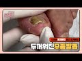 피부무좀에서 발톱까지 번져 발톱이 망가지신고객님 케어영상이예요. 병원치료 계속 잘 해주세요🙏🏻