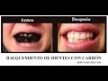 COMO BLANQUEAR  LOS DIENTES  NATURALMENTE EN CASA Y NATURAL/How to whiten teeth