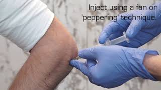 Injection Technique for Lateral Epicondylalgia