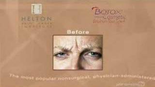 Botox will Remove Crow's Feet, Frown Lines and Laugh Lines