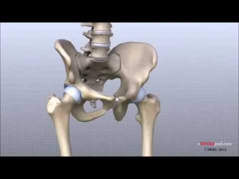 Video: 5 Klubo Osteoartrito Gydymo Galimybės