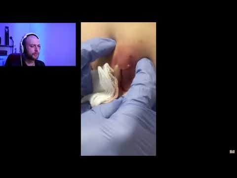 Video: Cyst Vs. Abses: Mengetahui Perbezaannya