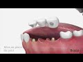 Pont sur implants dentaires