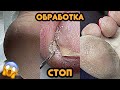 Педикюр обработка стоп 💅 Удаляем подногтевую мозоль / Летний матовый педикюр