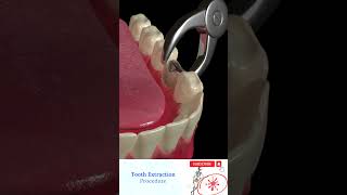 Tooth Extraction Animation - Aftercare View