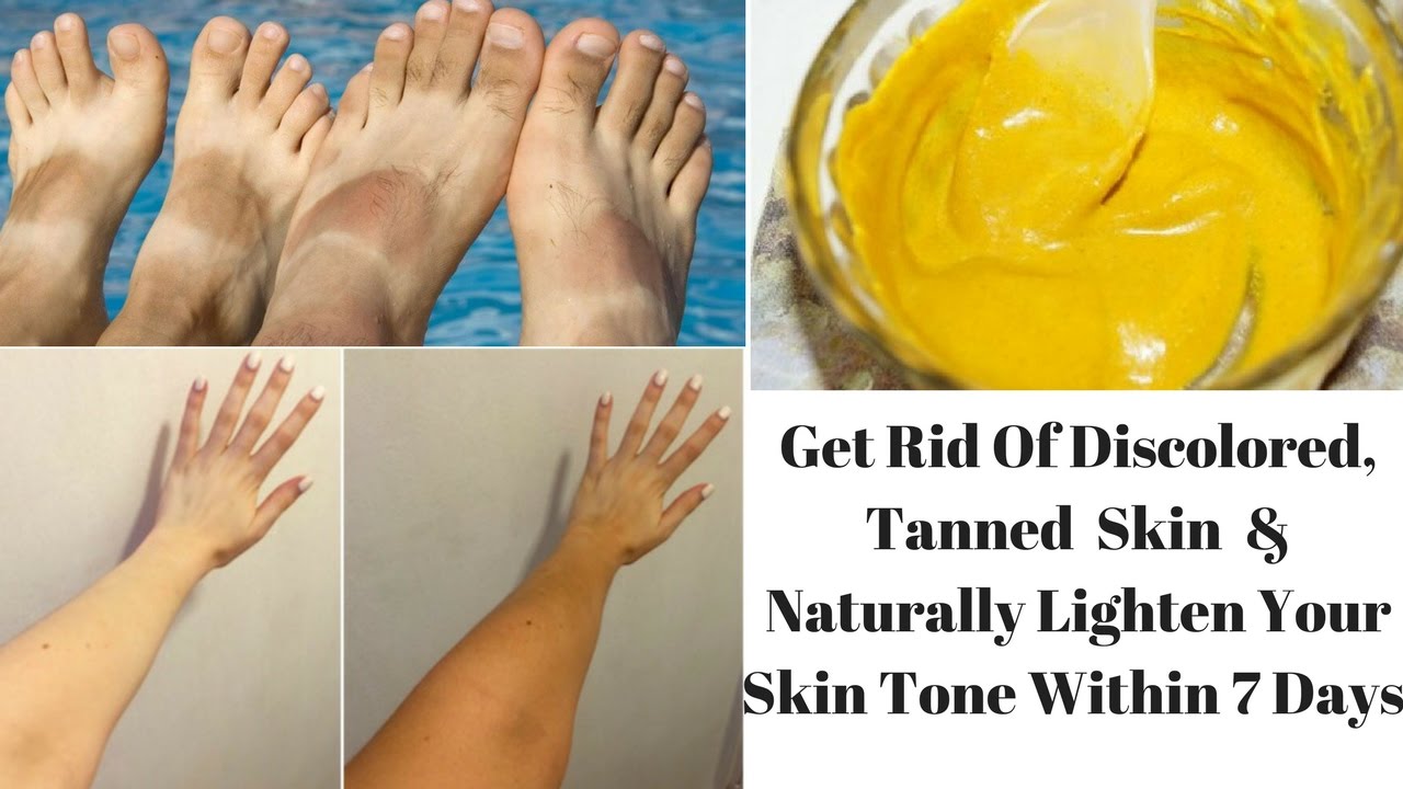how to get rid of discolored skin naturally