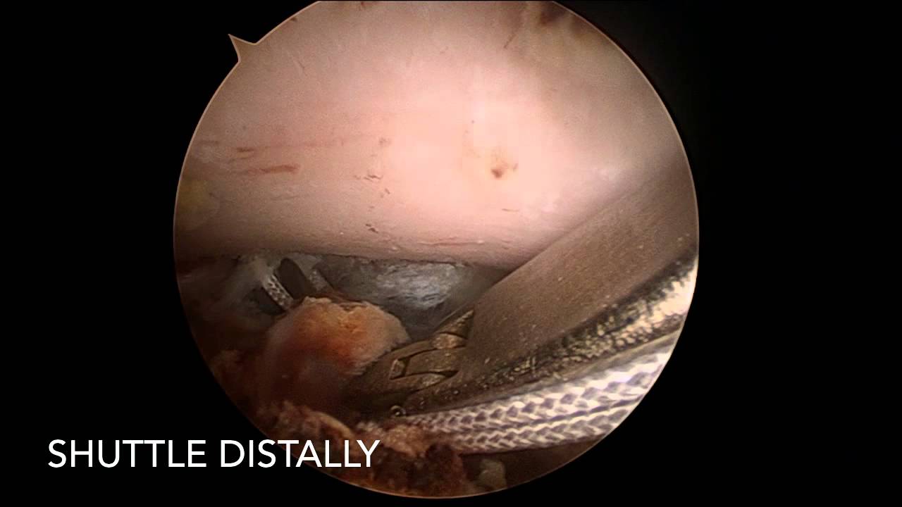 Ac Shoulder Dislocation
