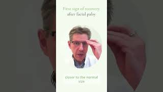 The first sign of recovery after facial palsy (Bell's palsy & Ramsay Hunt Syndrome)