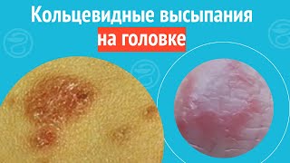 💍 Кольцевидные высыпания на головке. Клинический случай №1240