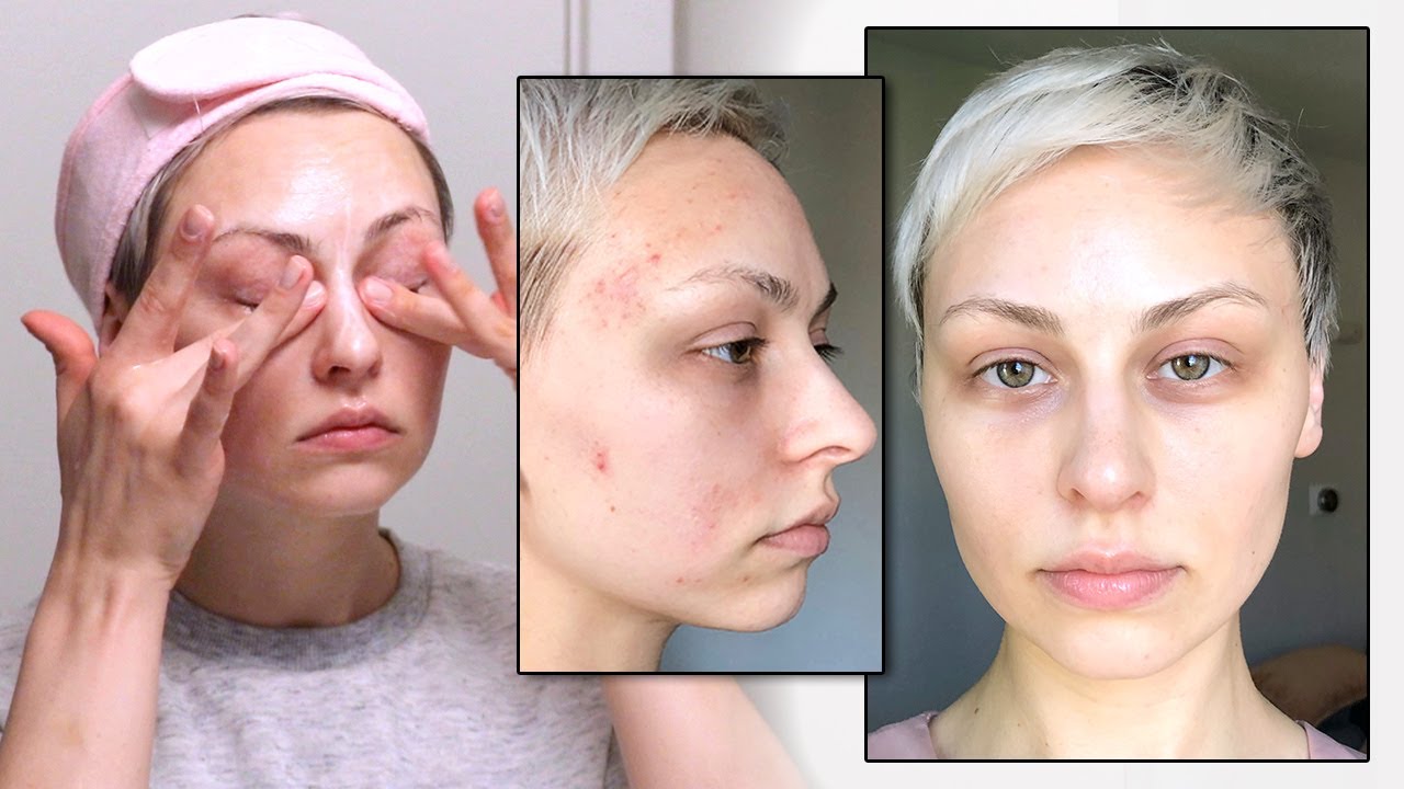 I FINALLY cleared up my skin - YouTube