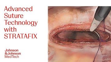 STRATAFIX Spiral Knotless Tissue Control Device with Plus Antibacterial Technology | J&J MedTech