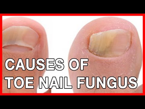 Nail And Toe Fungal Infection: Causes, Treatment, Home Remedies