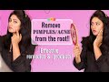 How I got rid of pimples/ance from the root||Effective & Easy Remedies||Lifestyle changes||Ashtrixx