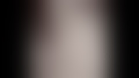 Uniportal Full Endoscopic Interbody Fusion in a Gr  2 Spondylolisthesis