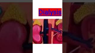 Dialysis......kidney failure...
