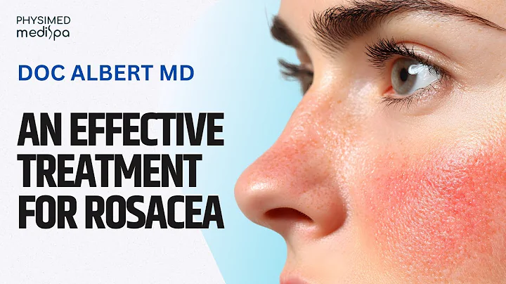 Rosacea: Understanding the Causes and Treatment Options