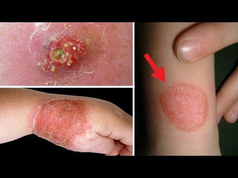 5-home-remedies-for-staph-infection-on-skin-||-cure-staph-infection-without-antibiotics