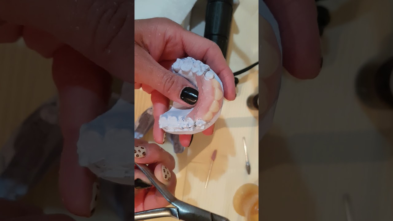 Ajuste y Rebase de protesis inmediata en modelo de yeso