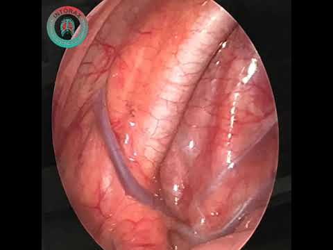 ANATOMÍA TORÁCICA, Caso: HIPERHIDROSIS