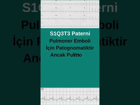 S1Q3T3 #ekg #kardiyoloji
