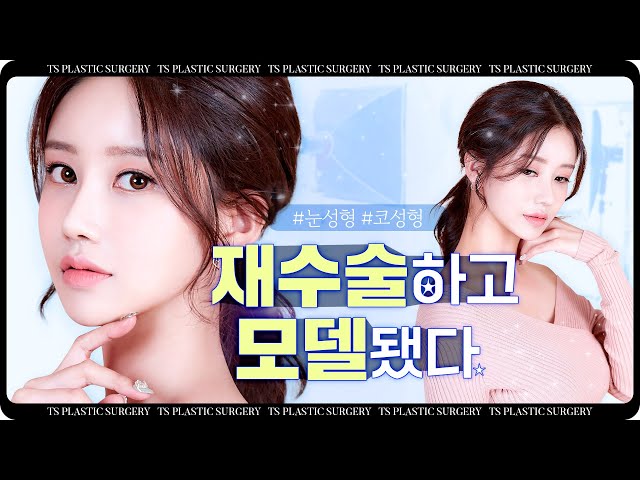 눈재수술, 코재수술하고 모델되었습니다 | 티에스성형외과