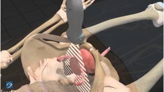 3D Comment : EFAST - Pelvis