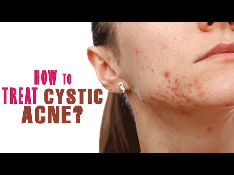 How To Treat Cystic Acne ?