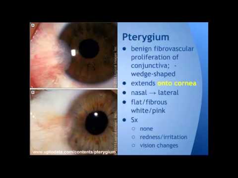 Wideo: Pterygium: Przyczyny, Objawy I Diagnoza