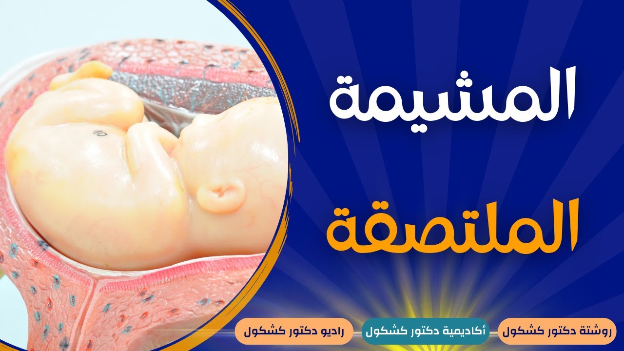 المشيمة الملتصقة | أعراضها وسببها وخطورتها وطريقة علاجها