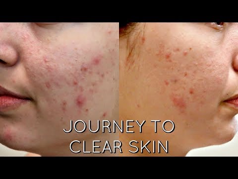 ACNE CHEMICAL PEEL - JOURNEY TO CLEAR SKIN