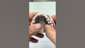 Super light Titanium partial