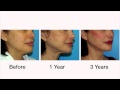 Fab At Any Age: Cosmetic Surgeon Dr. Giese and the Natural Lift