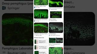 pemphigus vulgaris immunofluorescence
