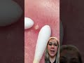 Vamos Remover A Acne Com Cuidado Olha Essa Super Dica Aí Vamos Remover A Acne Com Cuidado Olha Essa Super Dica Aí
