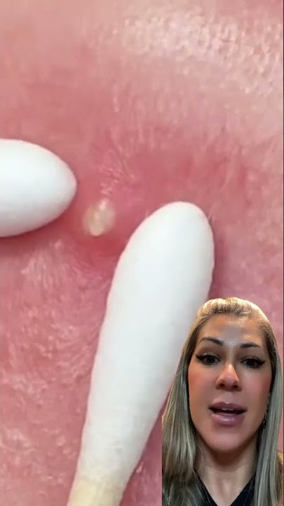 Vamos remover a acne com cuidado! Olha essa super dica aí!!!!