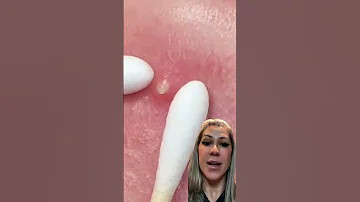 Vamos Remover A Acne Com Cuidado Olha Essa Super Dica Aí 