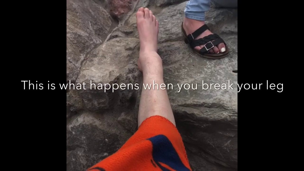 What it’s like to break you’re leg? YouTube
