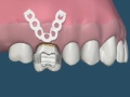 Intrusão dentária com o auxílio de mini implantes