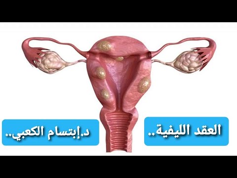 العقد الليفية الأعراض الأسباب العلاج د إبتسام الكعبي مركز ابتسام الطبي عجمان الإمارات