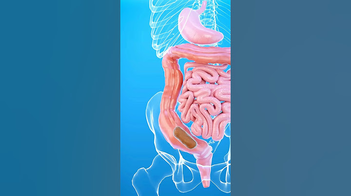 Qu'est-ce que la constipation ? 💩🤔