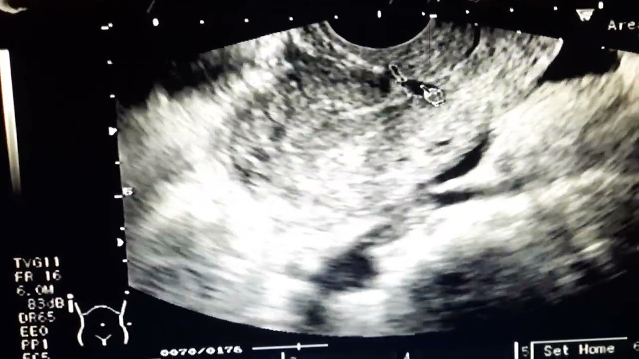 القيلة البرزخيّة Isthmocele