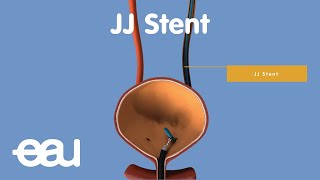 Behandlung von Nieren- und Harnleitersteinen: JJ-stent