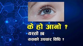 What Is Aano? This Is Its Treatment Method? Nepali Health Tips Swasthya Jankari