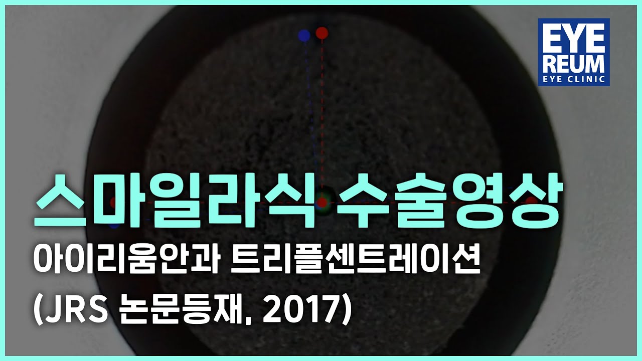 [愛利姆眼科診所] SMILE雷射手術影片 - 愛利姆眼科 三重對準術 (JRS 論文刊載, 2018)