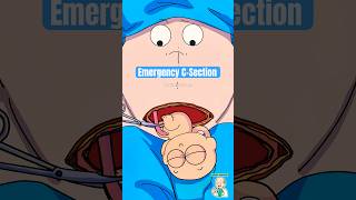 Emergency C-Section: When Natural Birth is Too Risky!🚨 #csectionbirth #animation