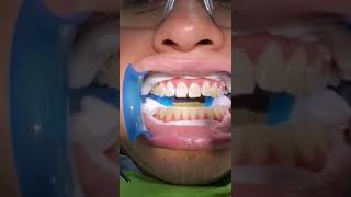 Así Se Hace Un Blanqueamiento Dental De Consultorio